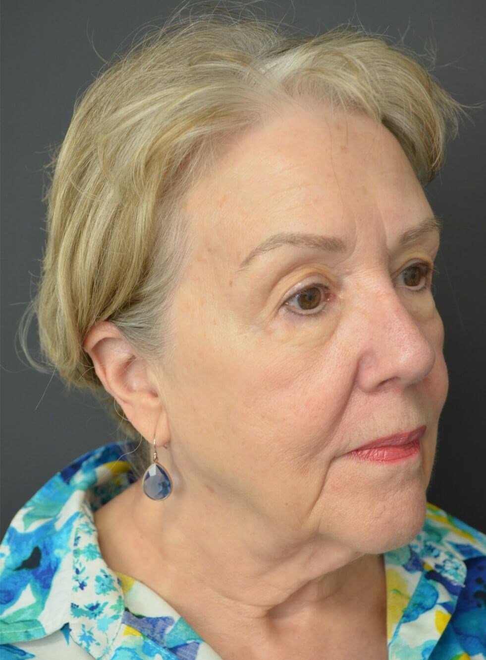 Deep plane face and necklift Before