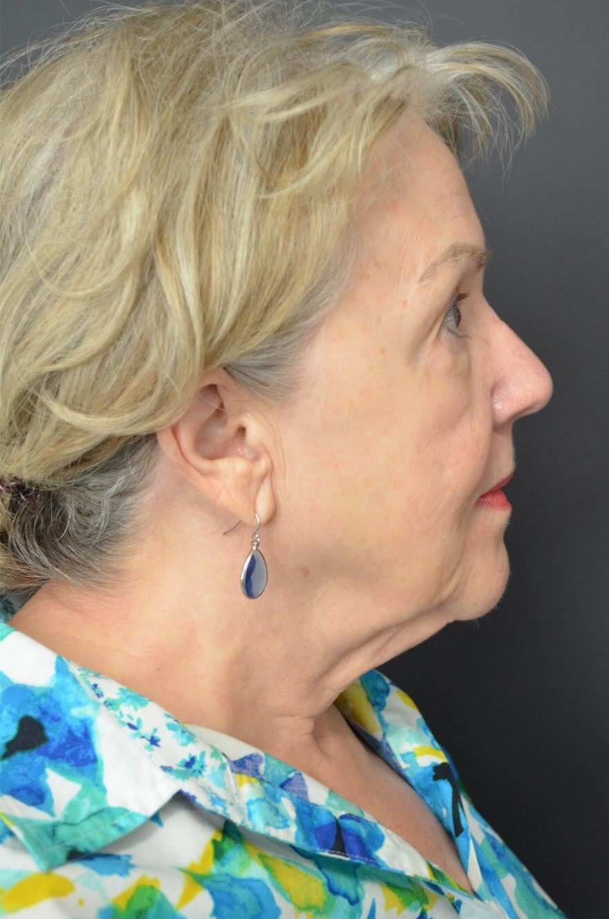Deep plane face and necklift Before
