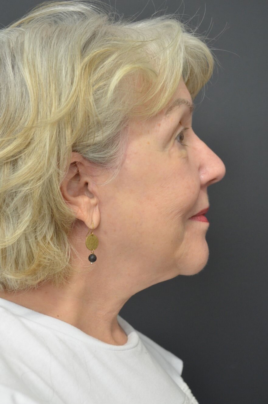 Deep plane face and necklift After