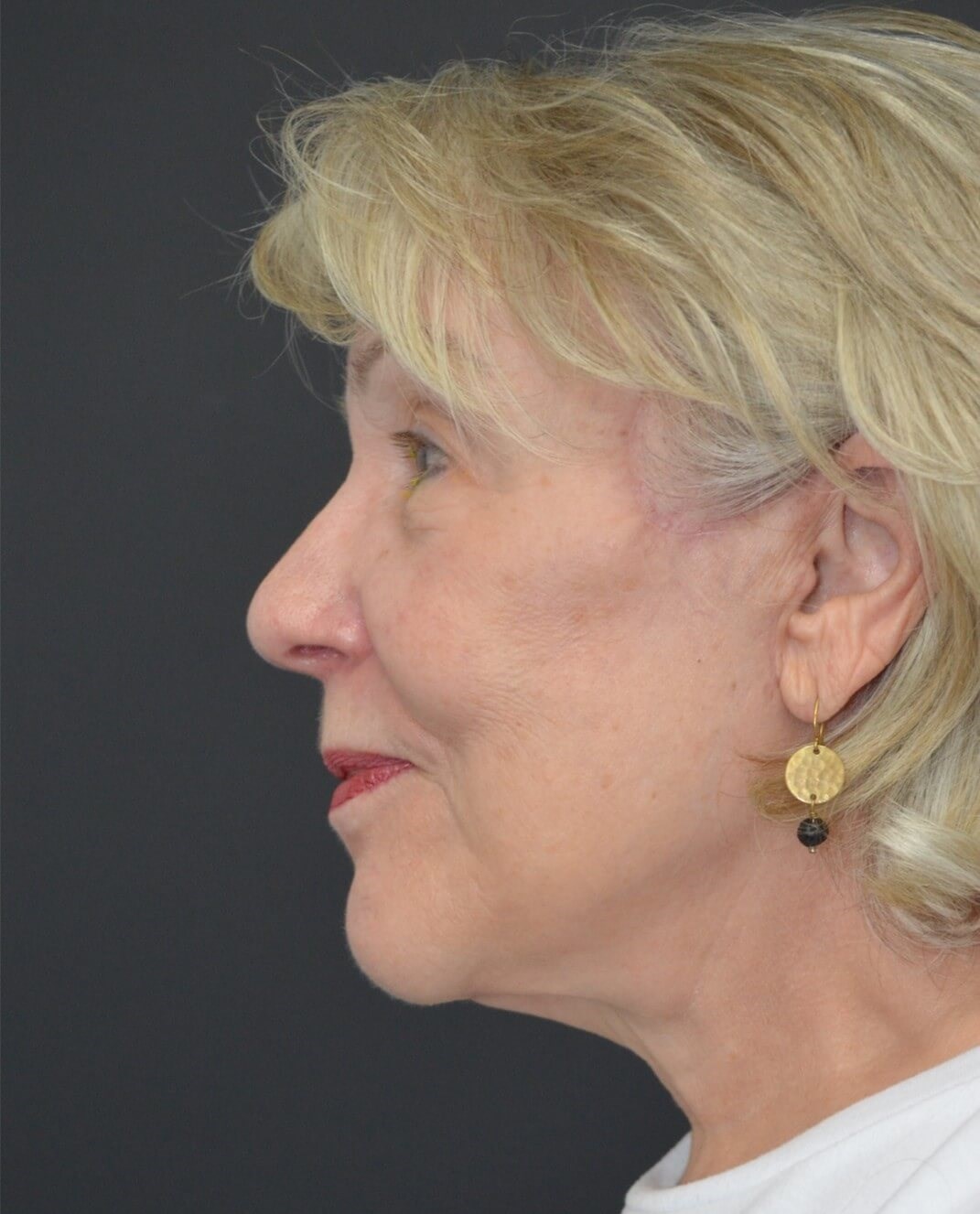 Deep plane face and necklift After