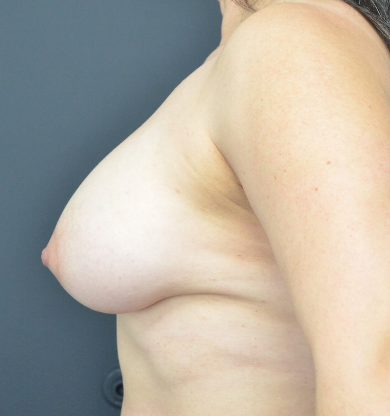 Breast Augmentation 510 cc mod After