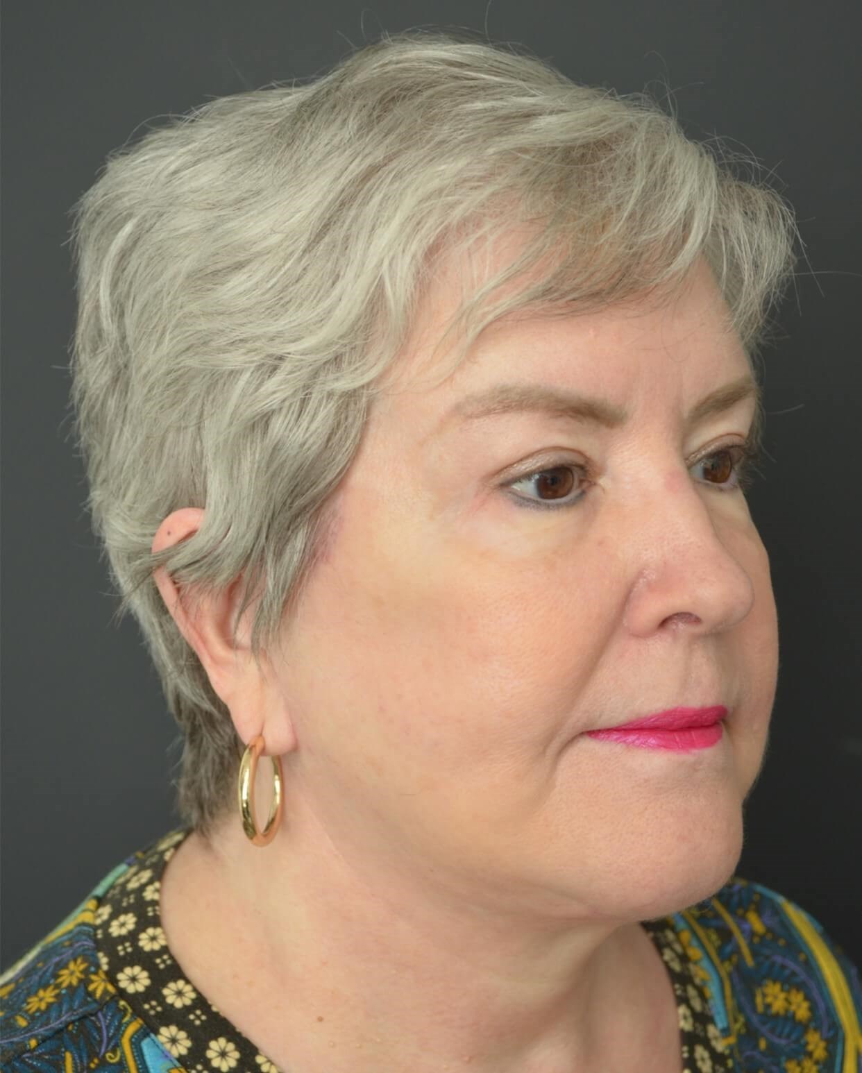 Deep plane face and necklift After