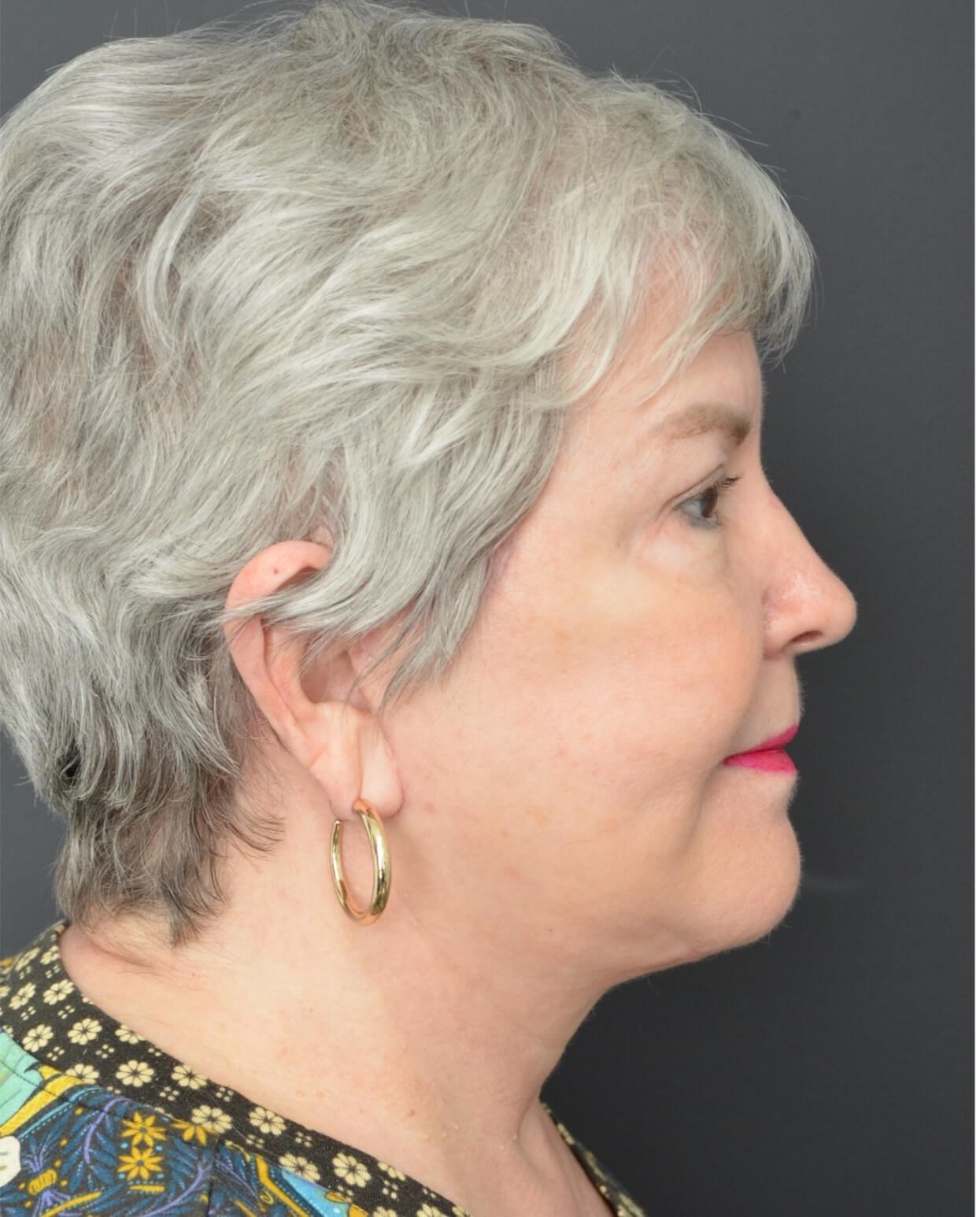 Deep plane face and necklift After