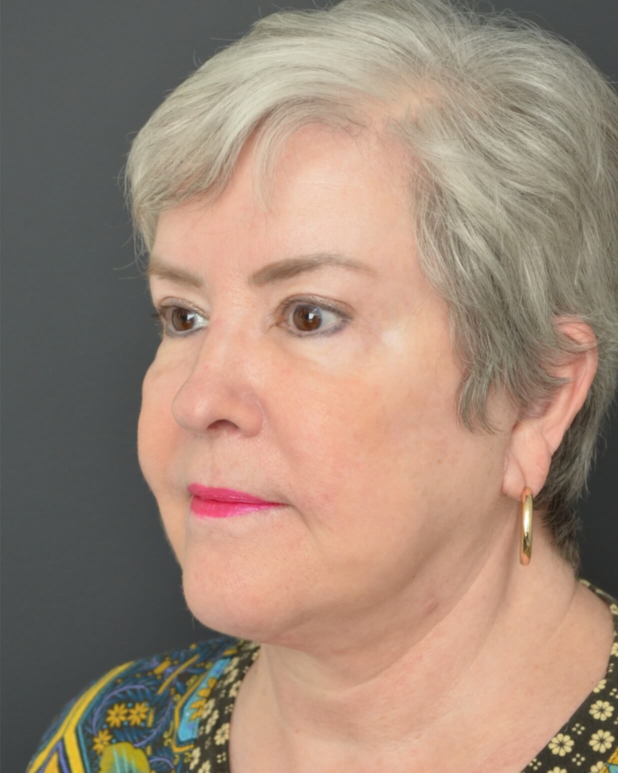 Deep plane face and necklift After