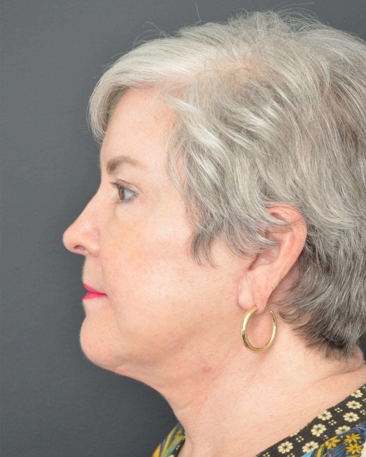Deep plane face and necklift After