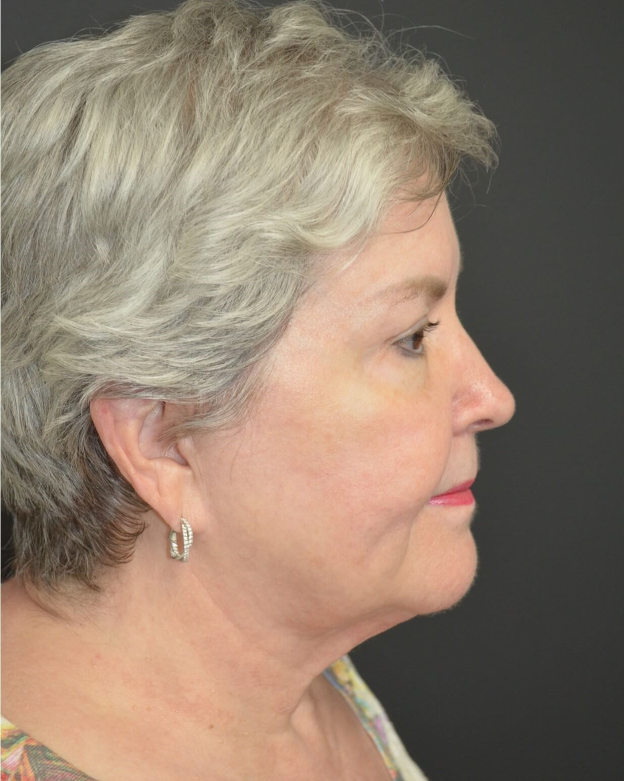 Deep plane face and necklift Before