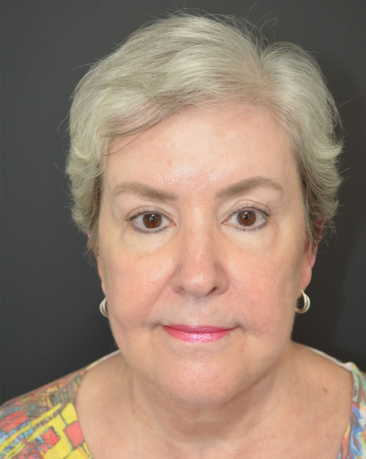 Deep plane face and necklift Before