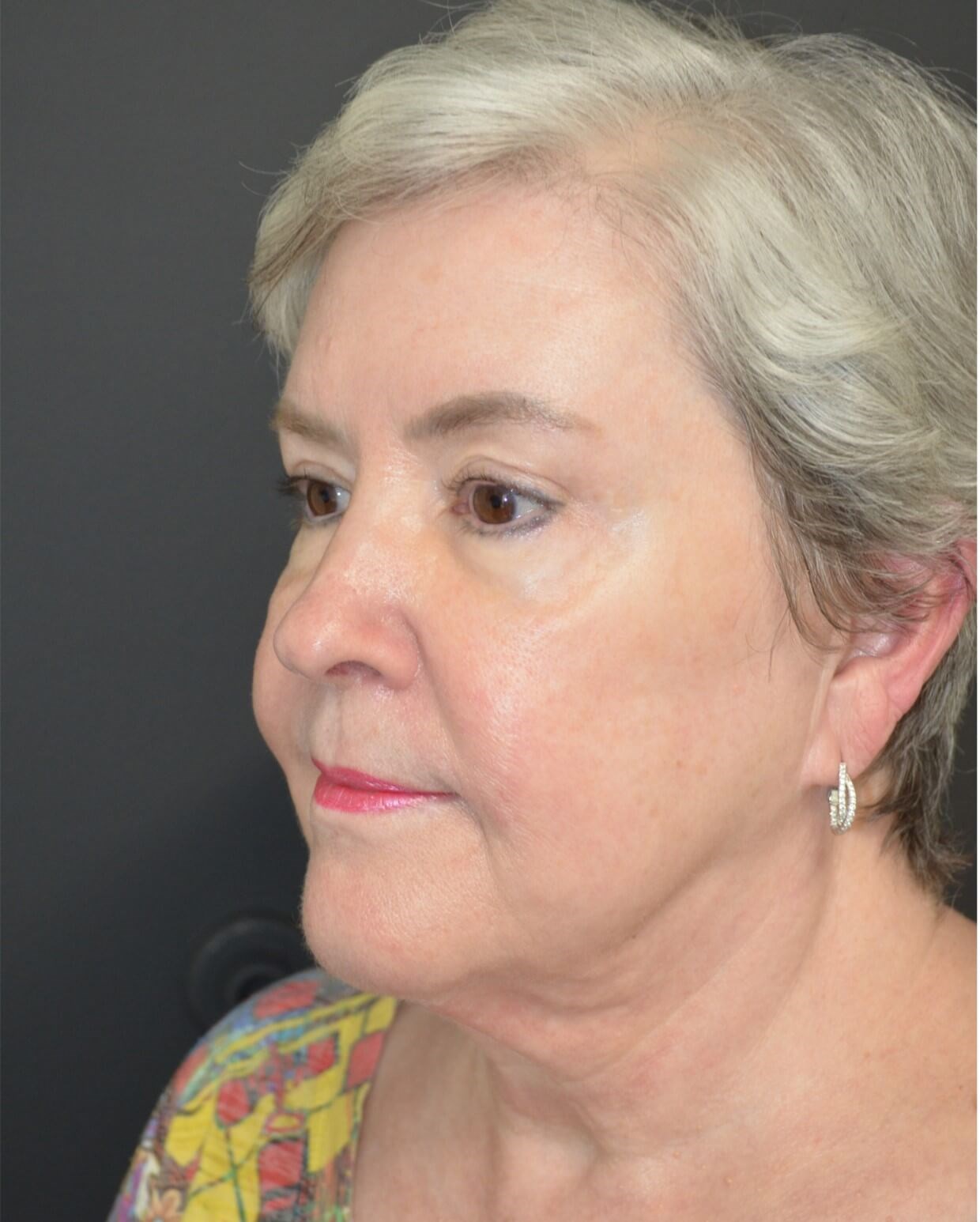 Deep plane face and necklift Before