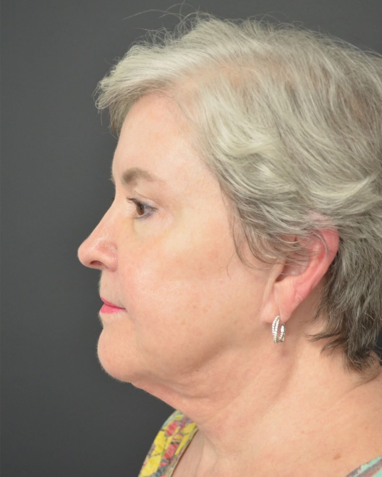 Deep plane face and necklift Before