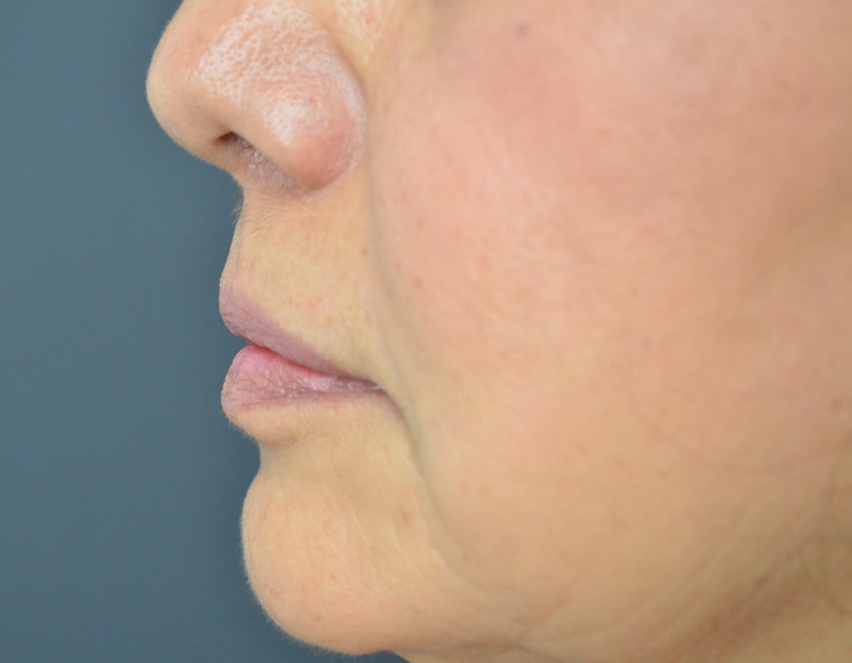 Bullhorn Lip Lift in Austin TX After