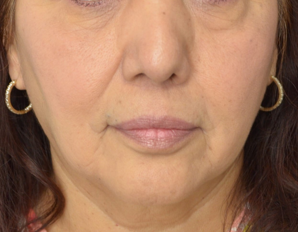 Bullhorn Lip Lift in Austin TX After