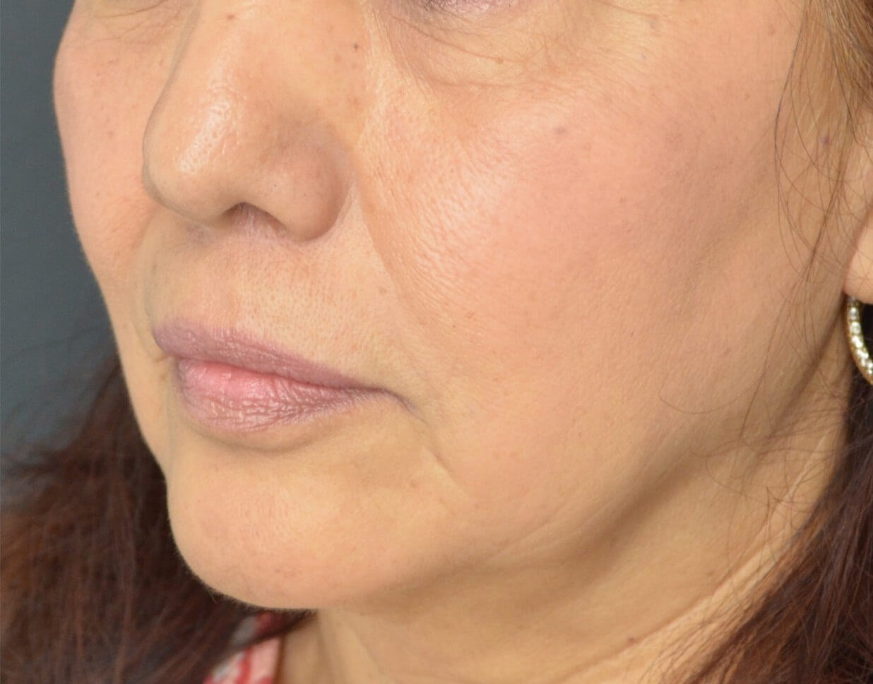 Bullhorn Lip Lift in Austin TX After