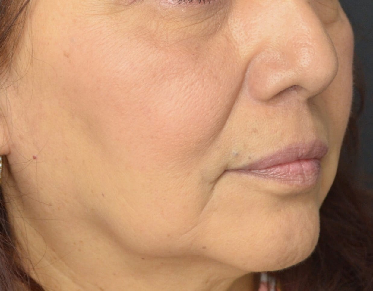 Bullhorn Lip Lift in Austin TX After