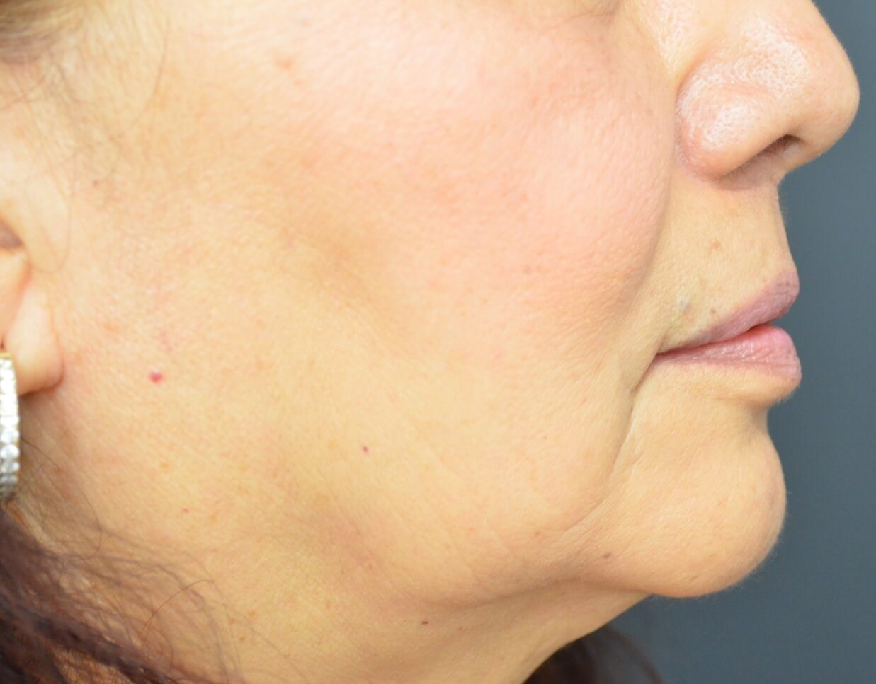 Bullhorn Lip Lift in Austin TX After