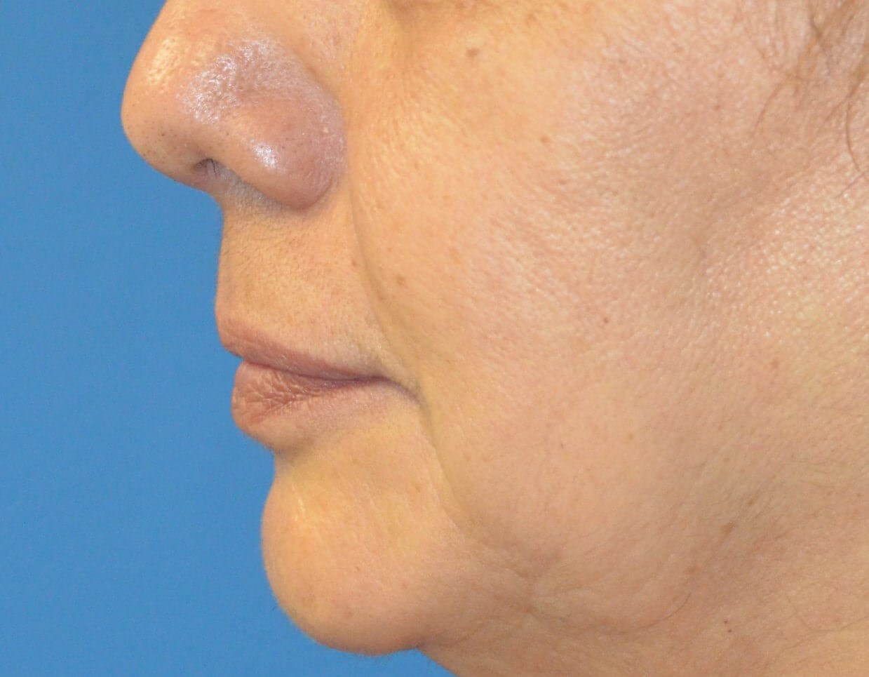 Bullhorn Lip Lift in Austin TX Before