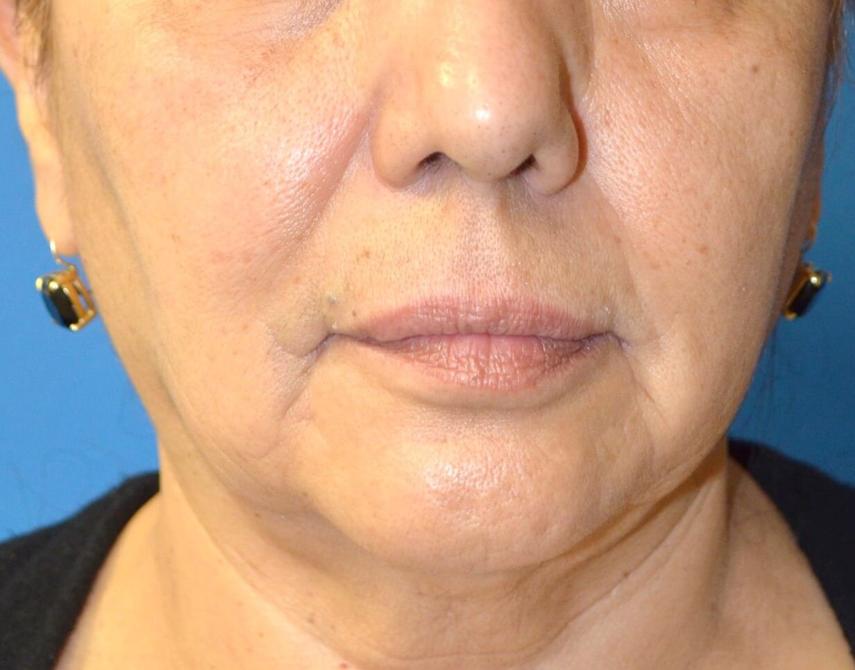 Bullhorn Lip Lift in Austin TX Before