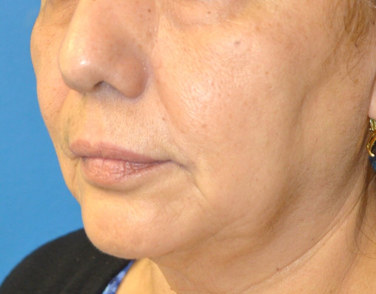 Bullhorn Lip Lift in Austin TX Before