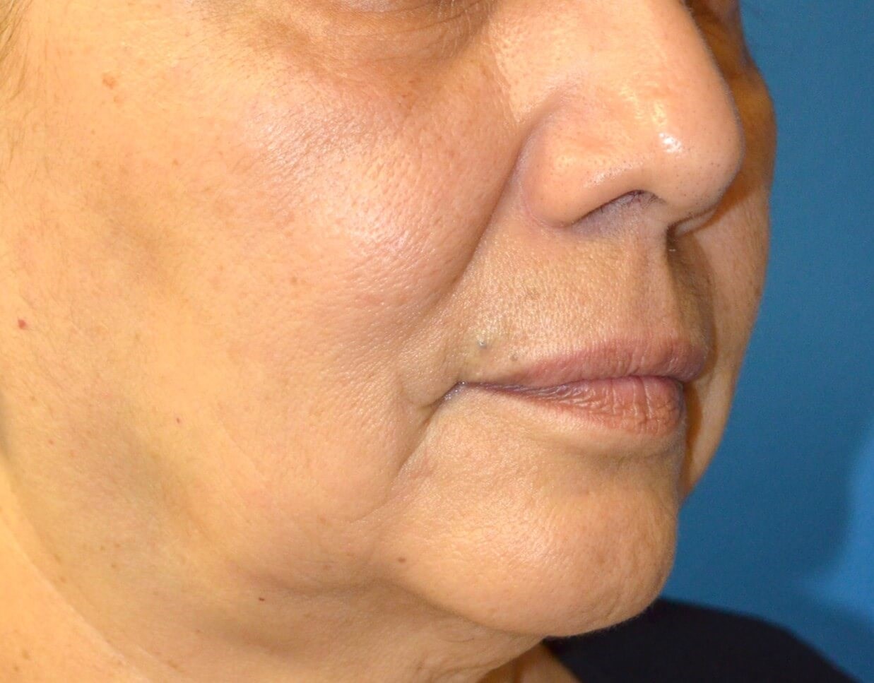 Bullhorn Lip Lift in Austin TX Before