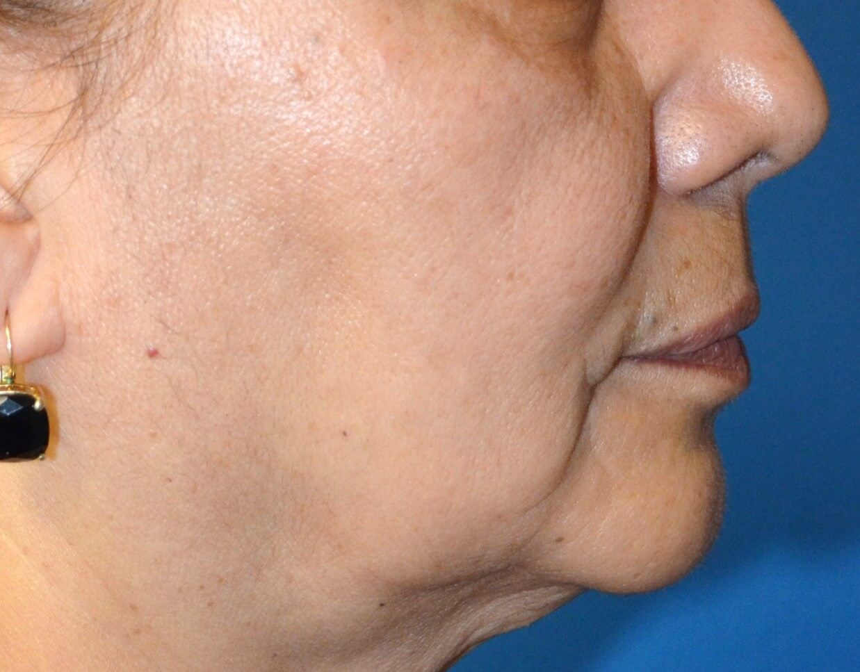 Bullhorn Lip Lift in Austin TX Before
