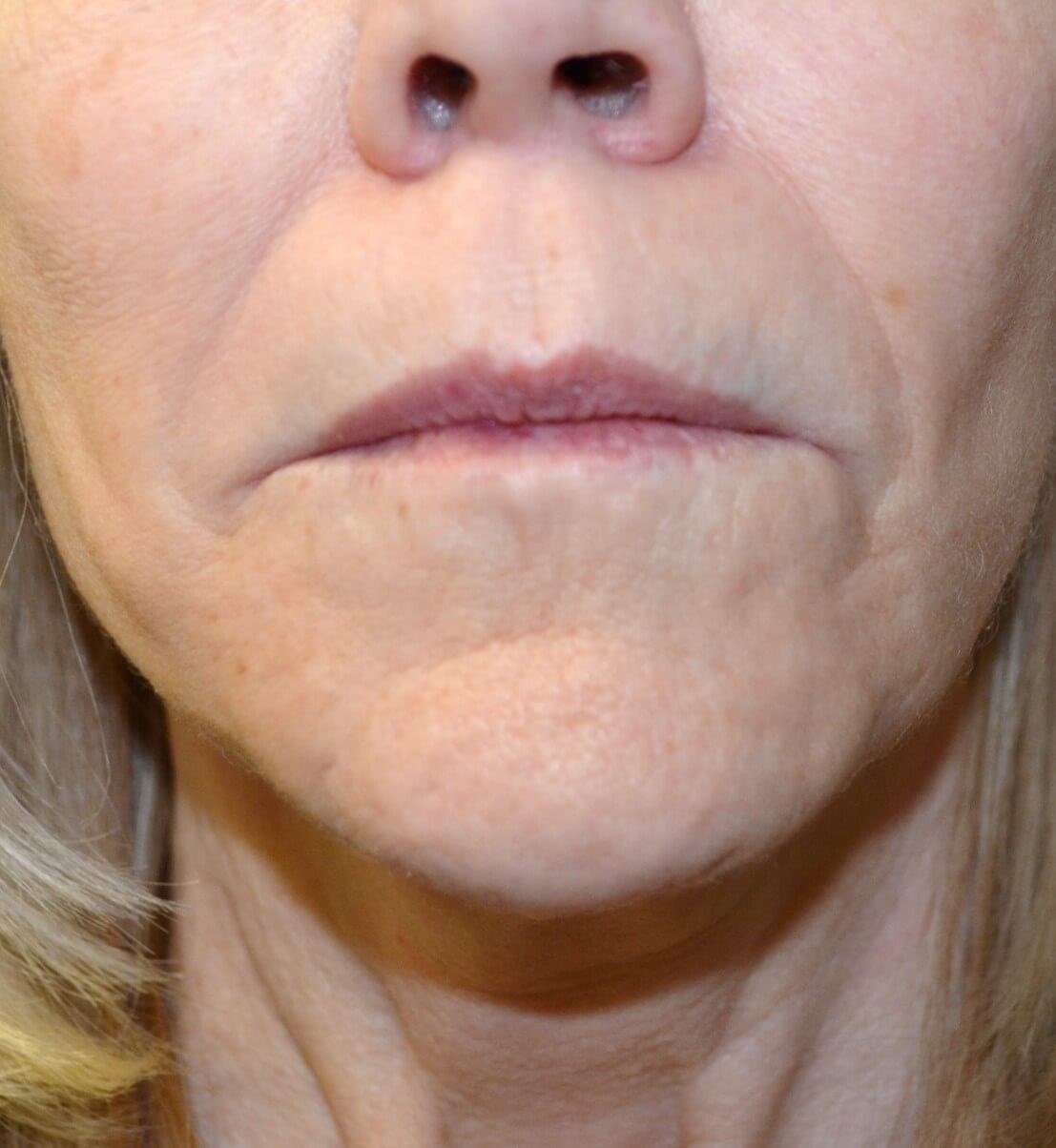Bullhorn Lip Lift in Austin TX Before