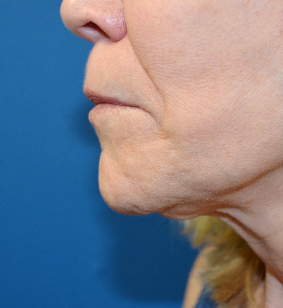 Bullhorn Lip Lift in Austin TX Before