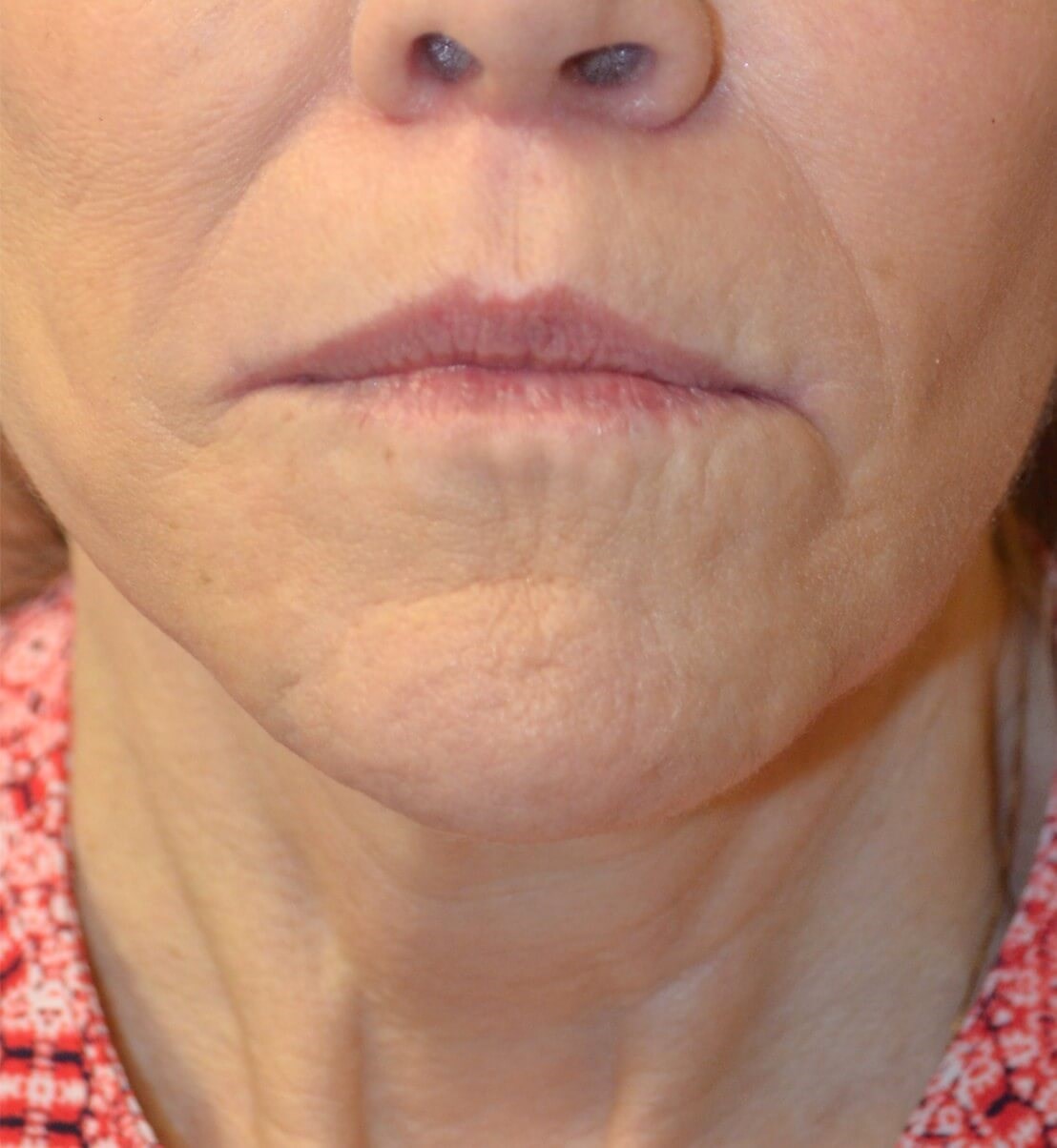 Bullhorn Lip Lift in Austin TX After