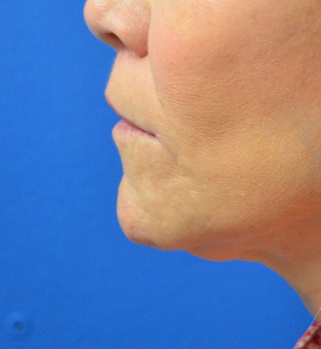 Bullhorn Lip Lift in Austin TX After