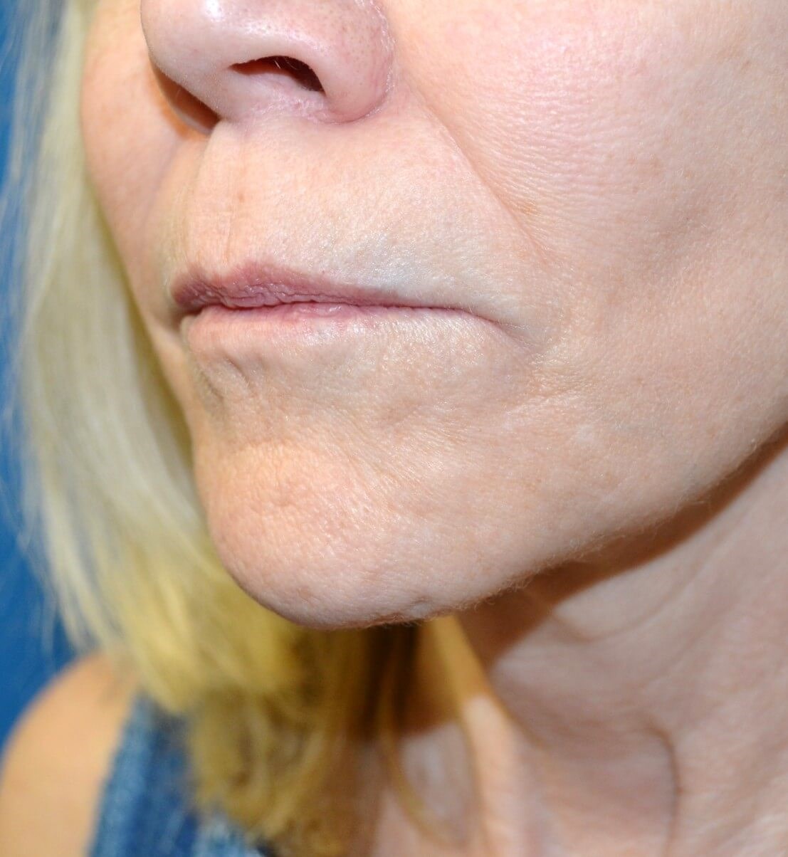 Bullhorn Lip Lift in Austin TX Before