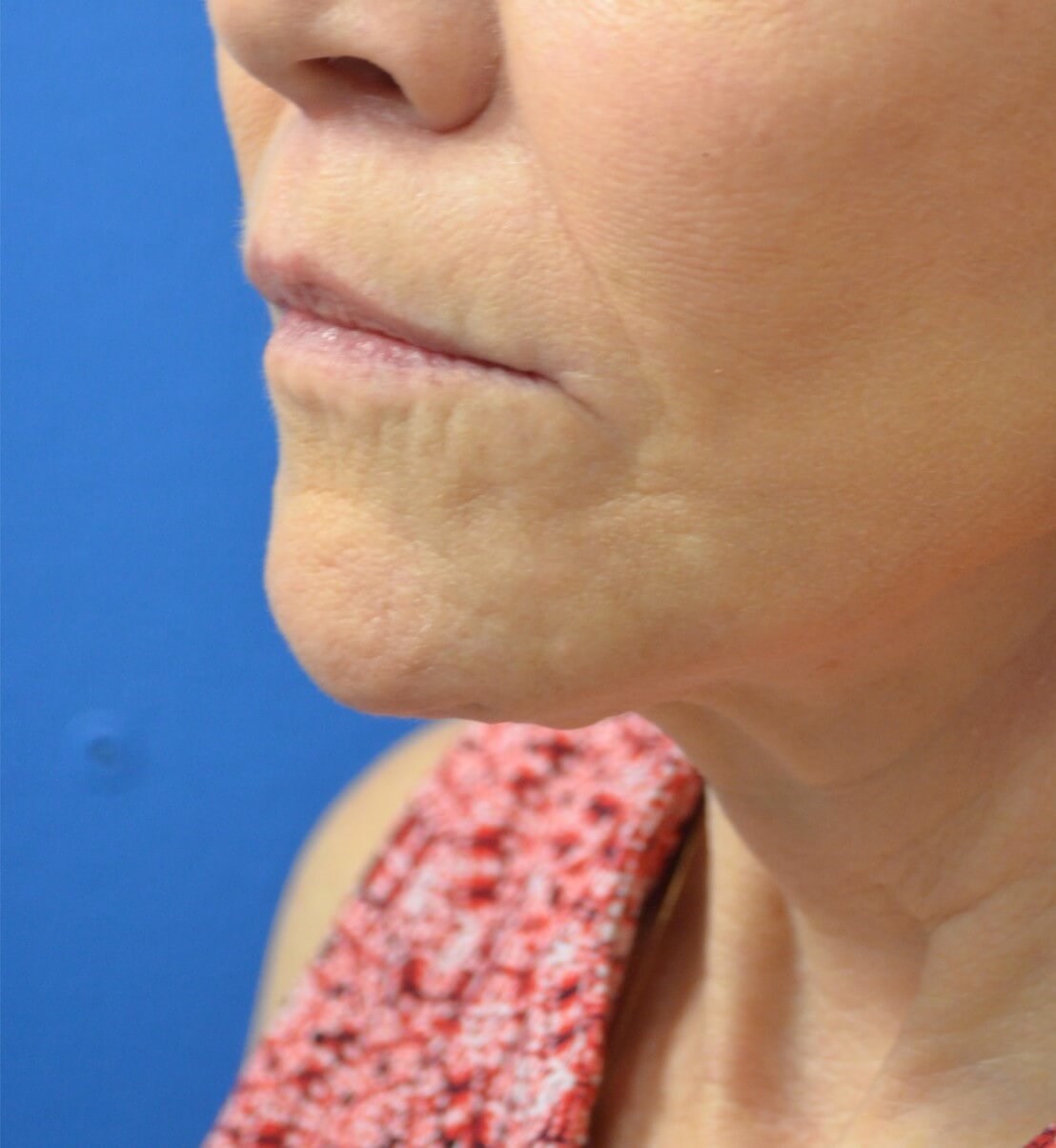 Bullhorn Lip Lift in Austin TX After