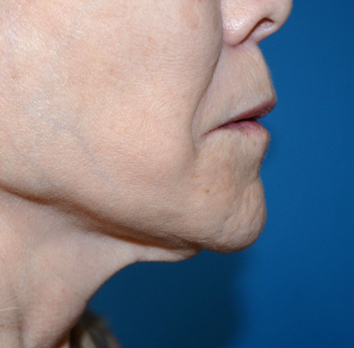 Bullhorn Lip Lift in Austin TX Before