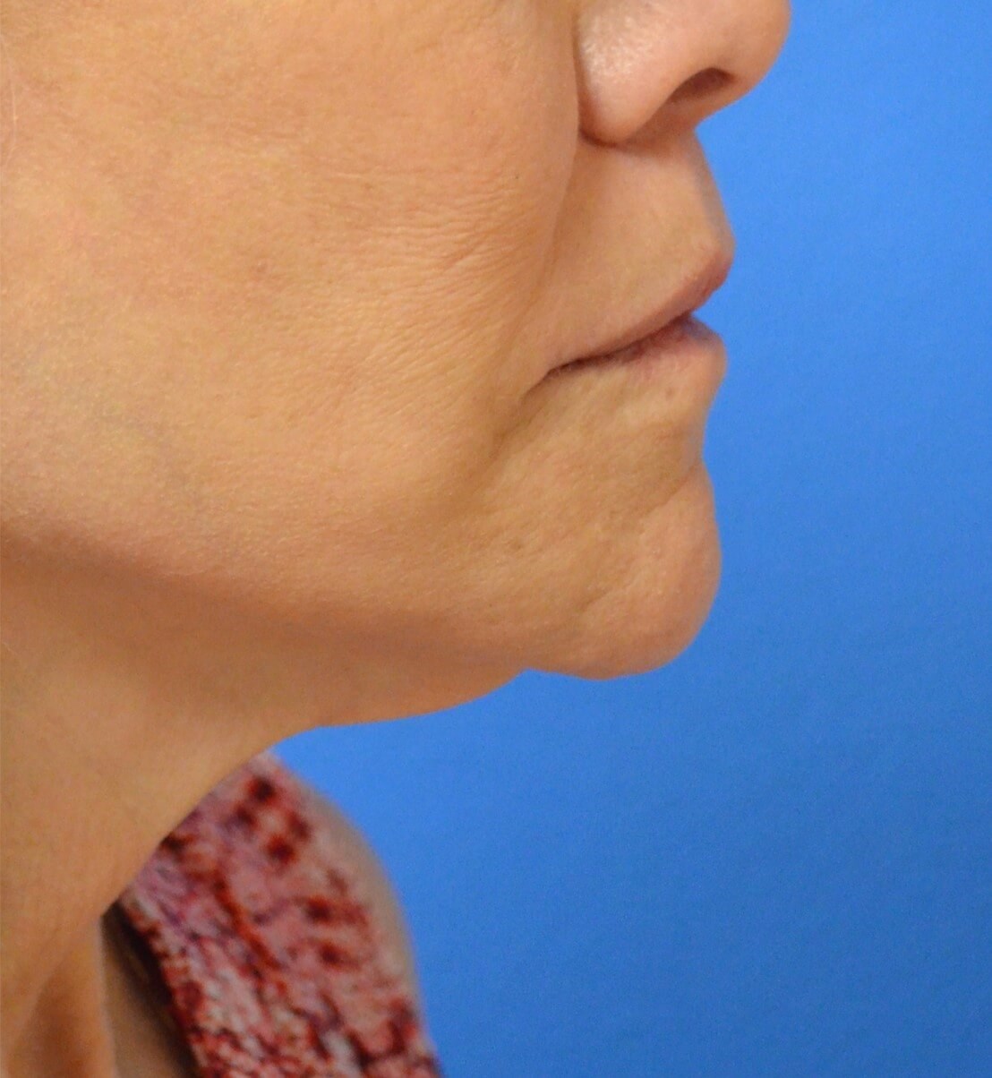 Bullhorn Lip Lift in Austin TX After