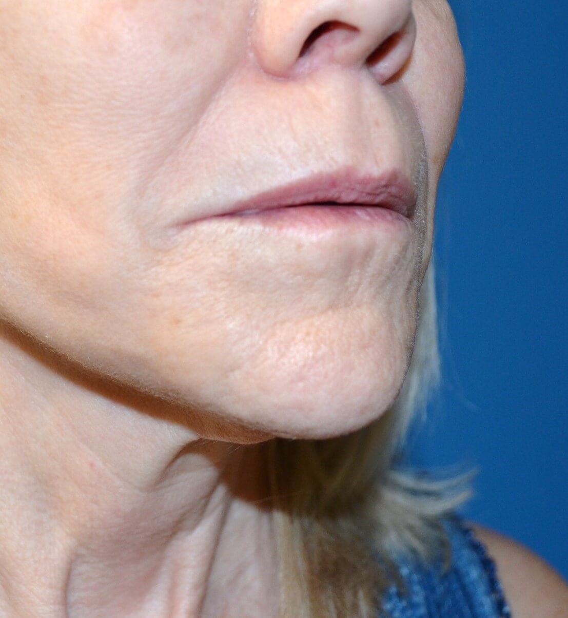 Bullhorn Lip Lift in Austin TX Before