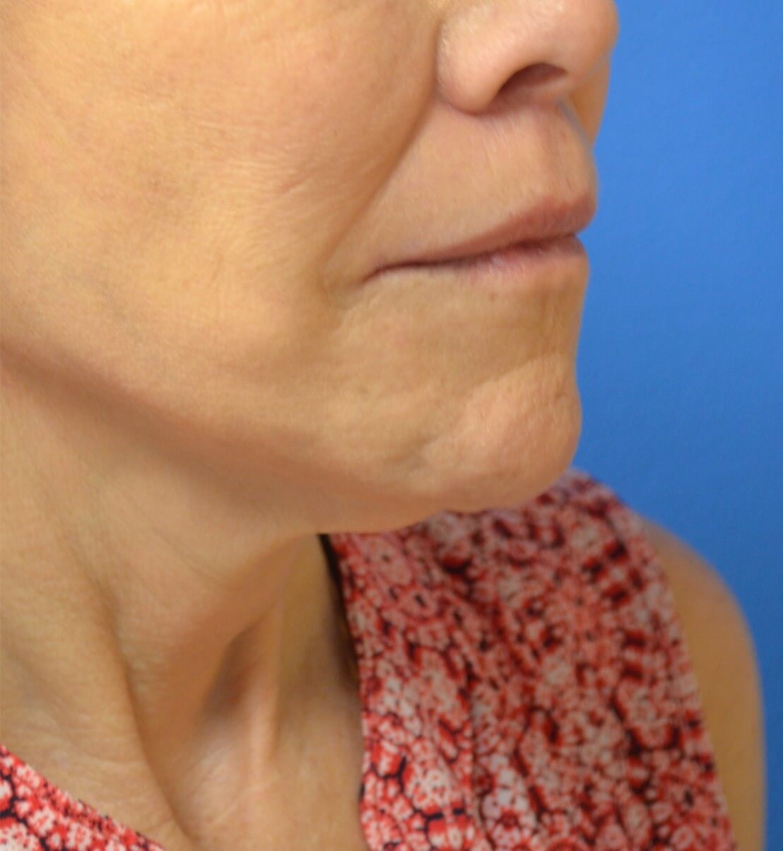 Bullhorn Lip Lift in Austin TX After