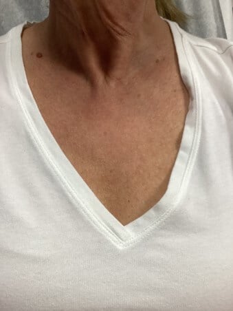 Intense Pulse Light Therapy After