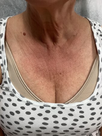 Intense Pulse Light Therapy Before