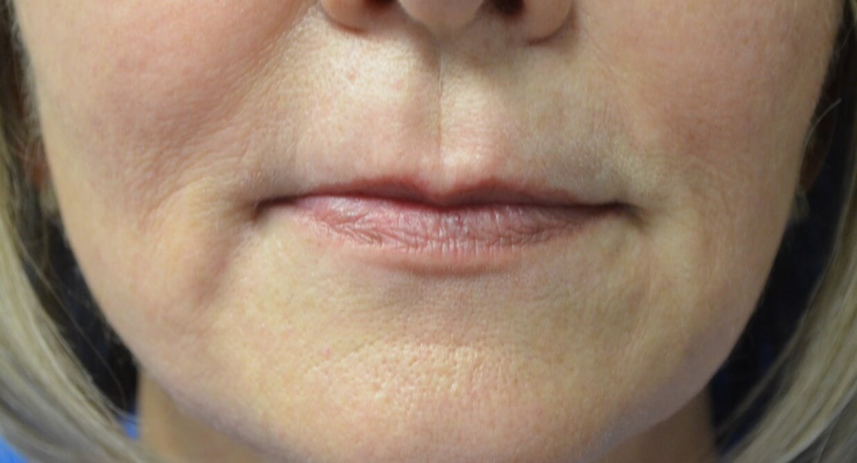 Restylane Kysse for Lips Before