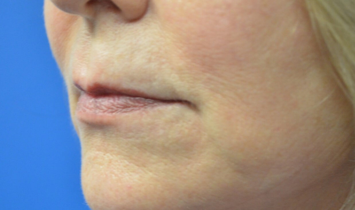 Restylane Kysse for Lips Before