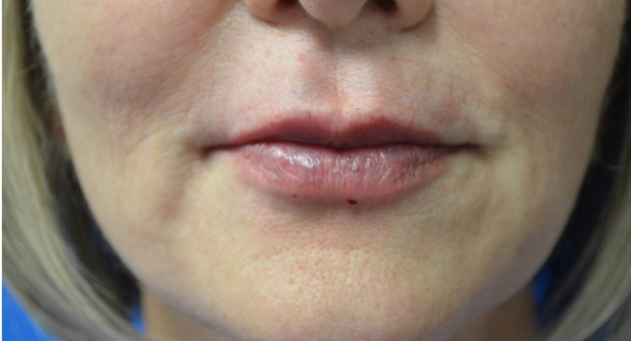 Restylane Kysse for Lips After