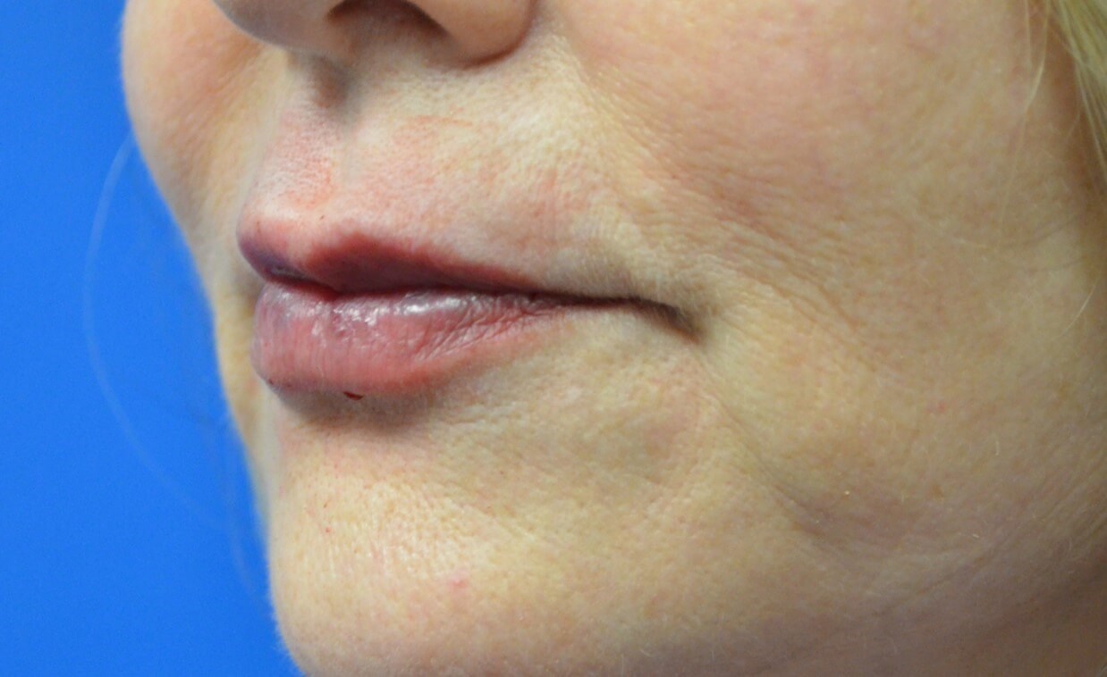 Restylane Kysse for Lips After