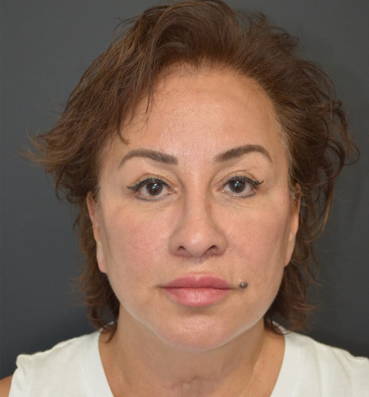Deep plane face and necklift After