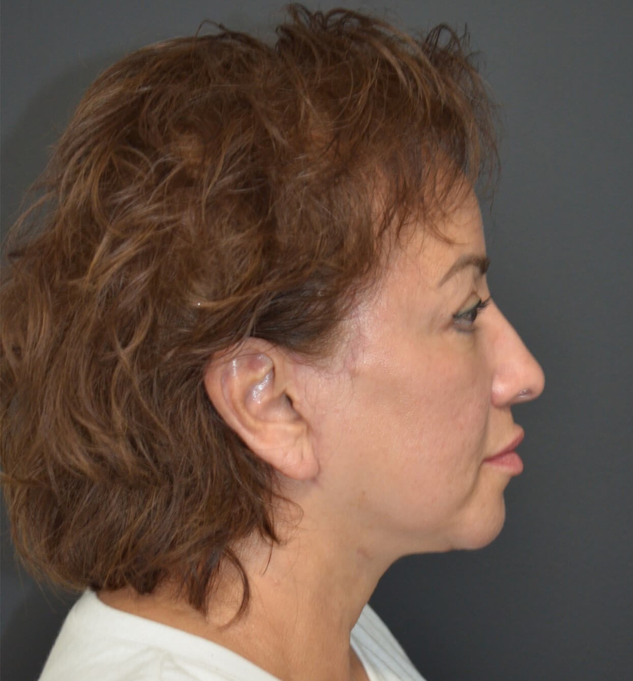 Deep plane face and necklift After