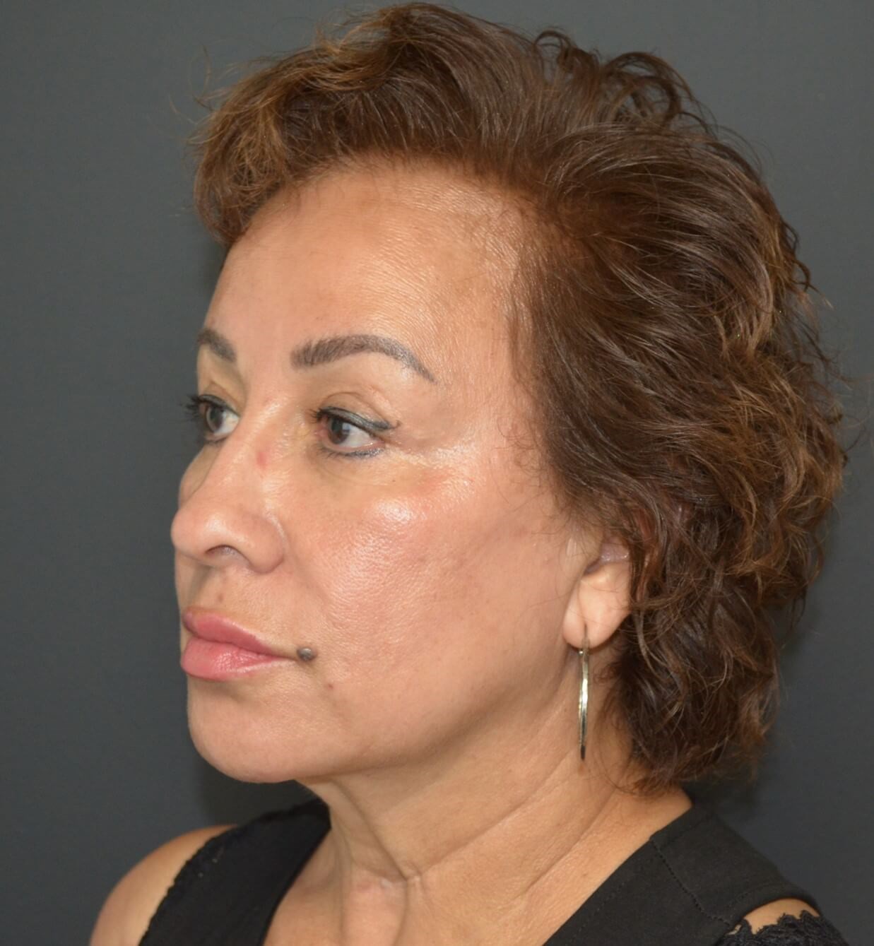Deep plane face and necklift Before