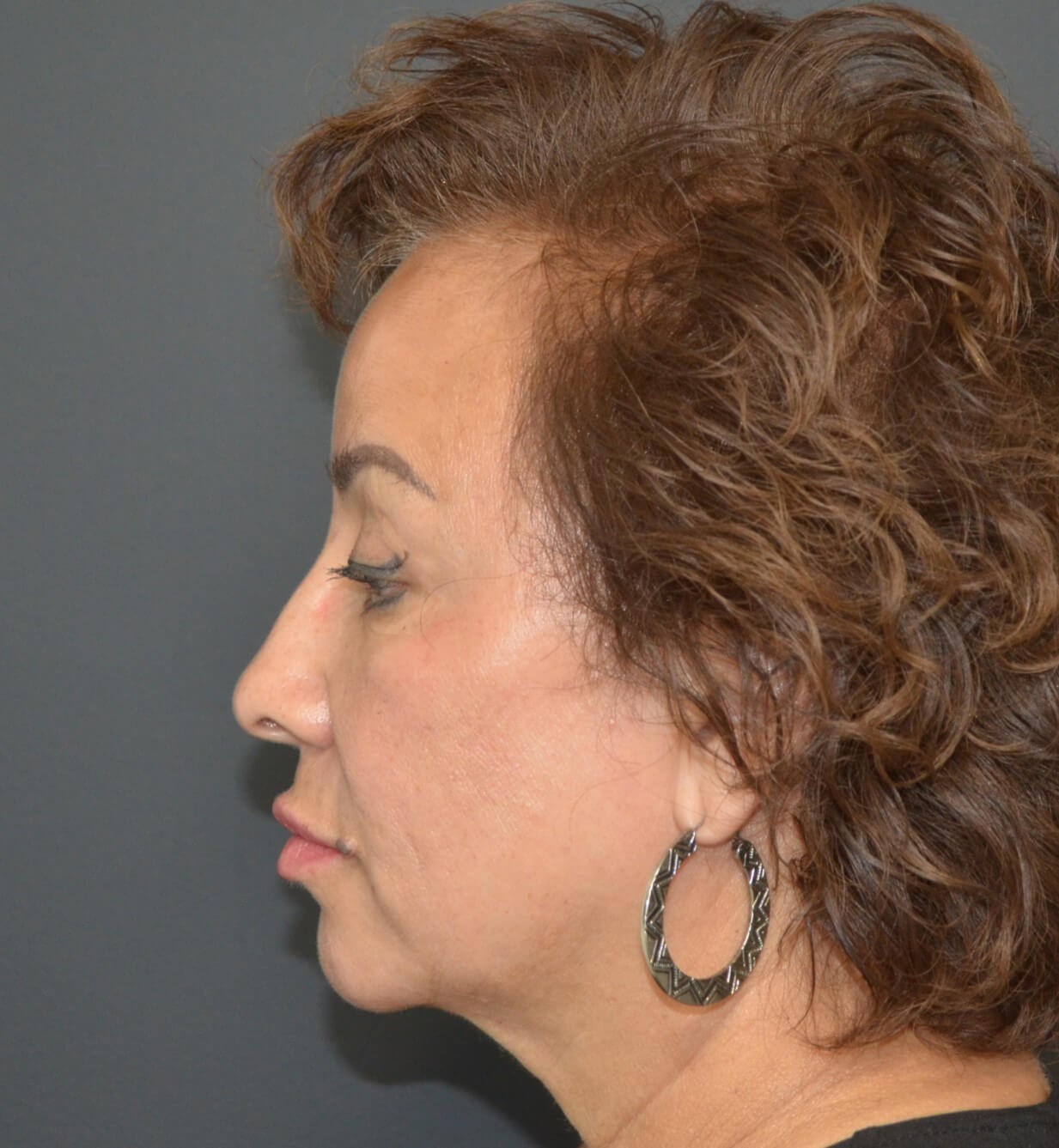 Deep plane face and necklift Before