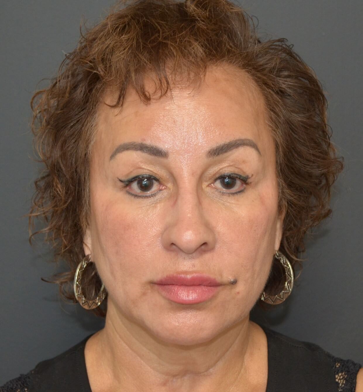 Deep plane face and necklift Before