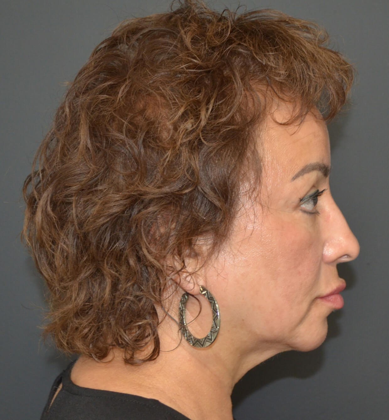 Deep plane face and necklift Before