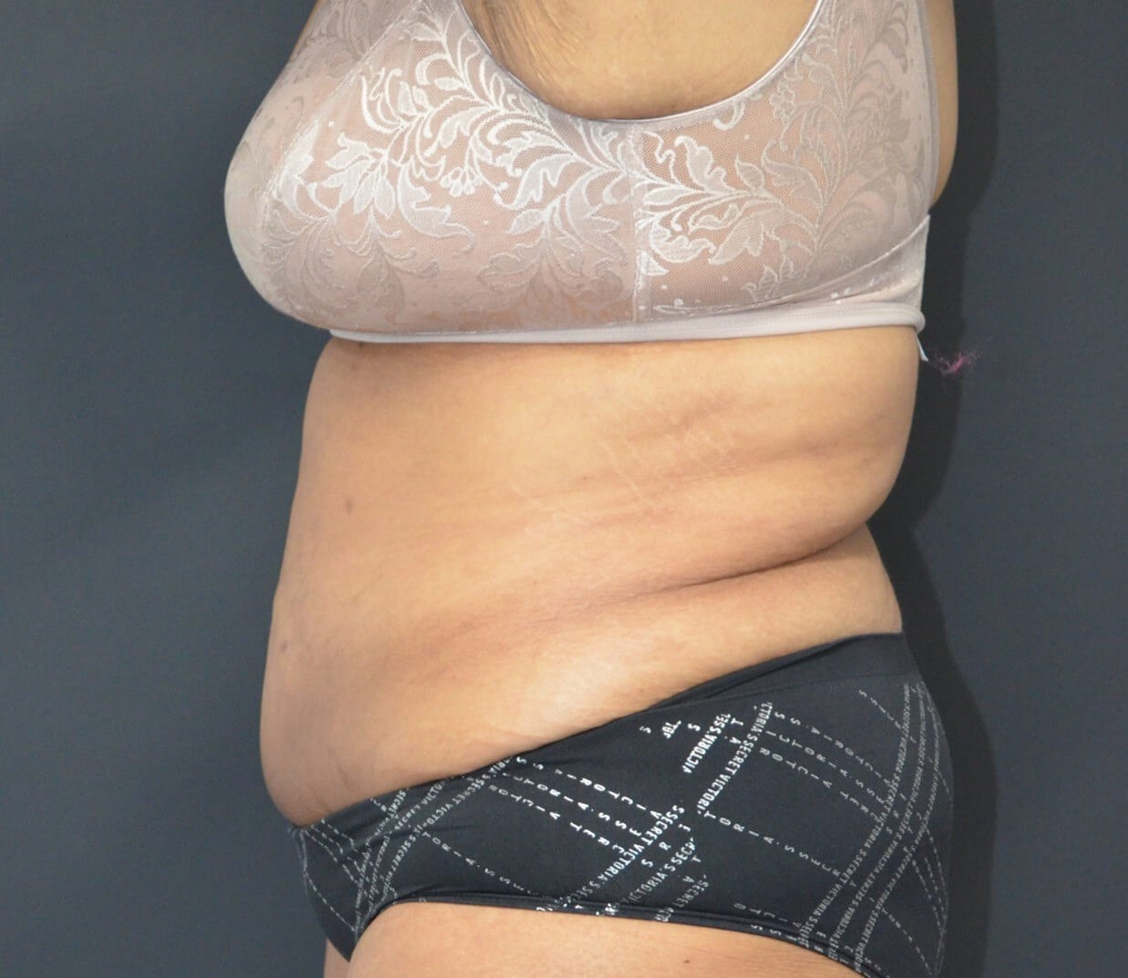 Lipoabdominoplasty After