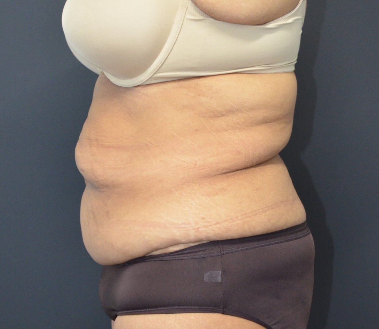 Lipoabdominoplasty Before