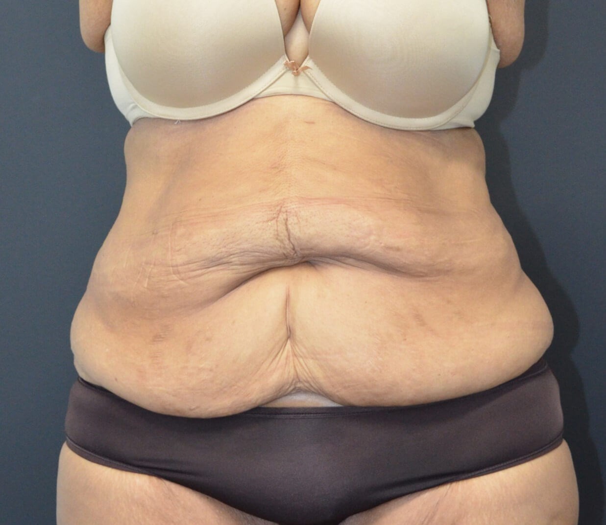 Lipoabdominoplasty Before