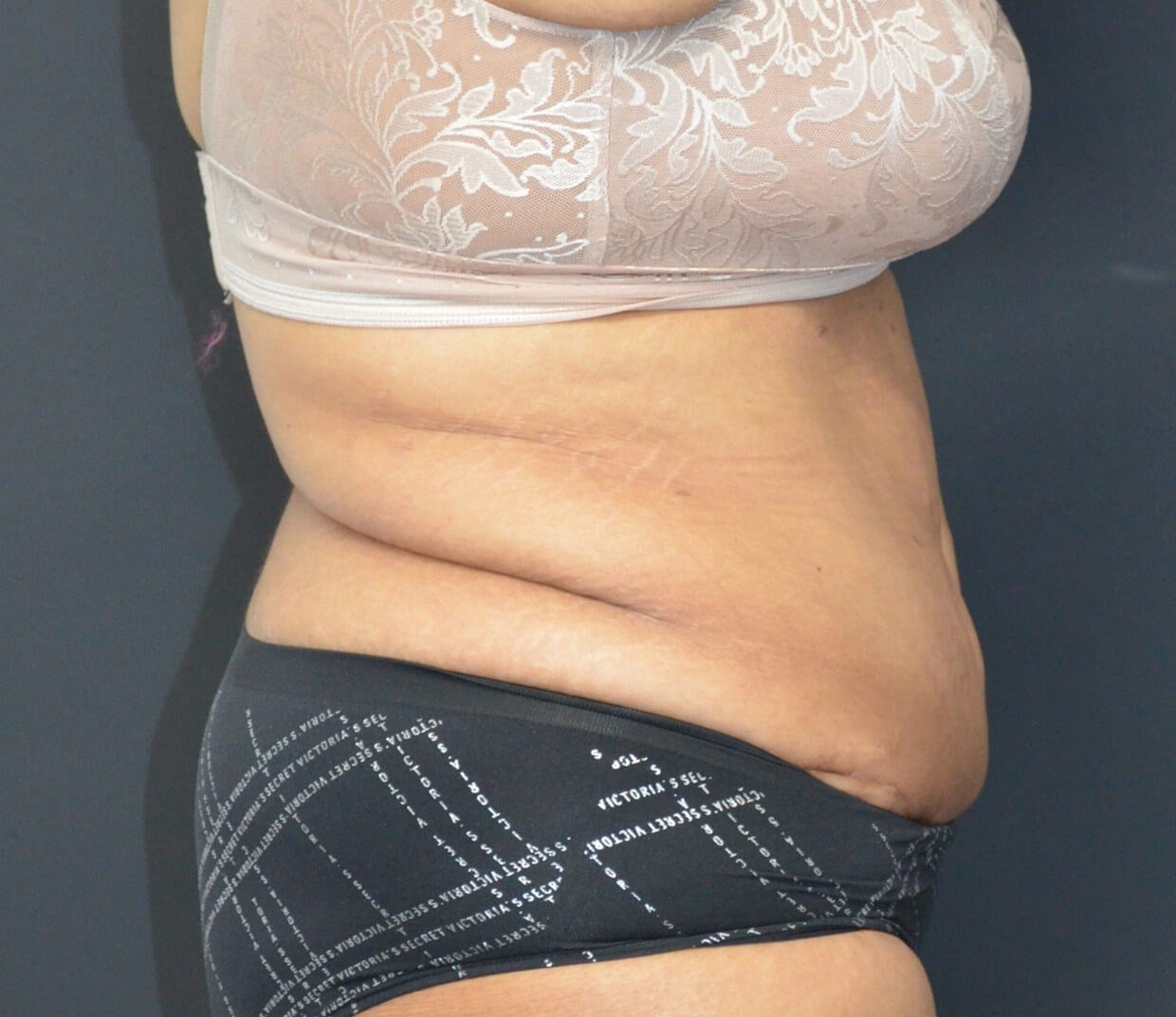 Lipoabdominoplasty After