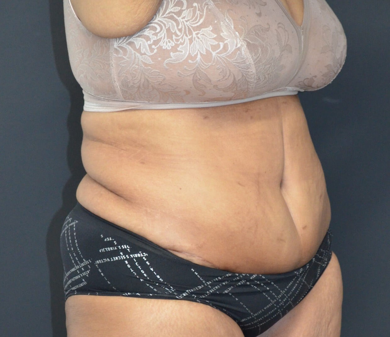 Lipoabdominoplasty After